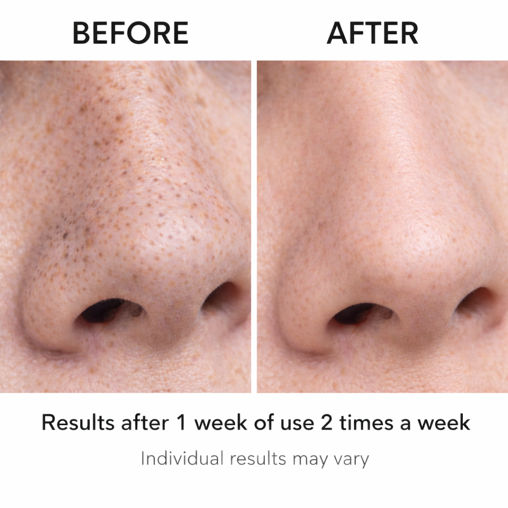 Close-up before and after image showing reduced blackheads and clearer pores on the nose after 1 week of using the Pore Perfect blackhead remover device twice weekly