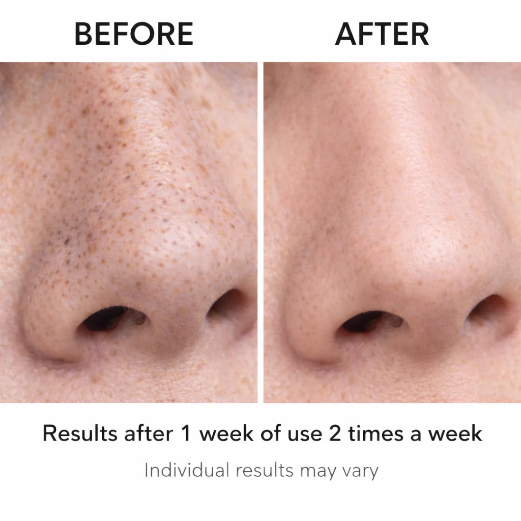 Before and after close-up of nose pores after using Sheskn Pore Perfect blackhead remover