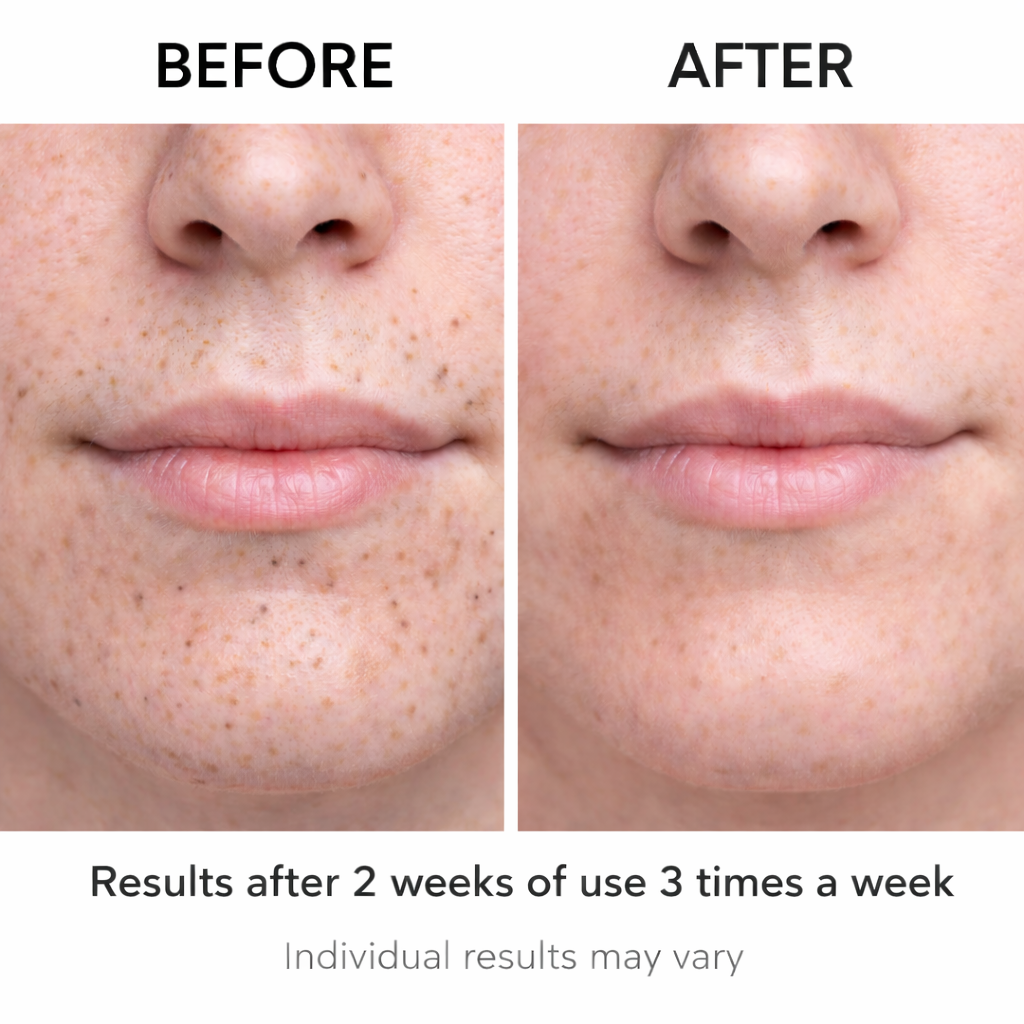 Before and after image of chin and cheeks showing fewer blackheads after 2 weeks of using a blackhead remover device three times a week