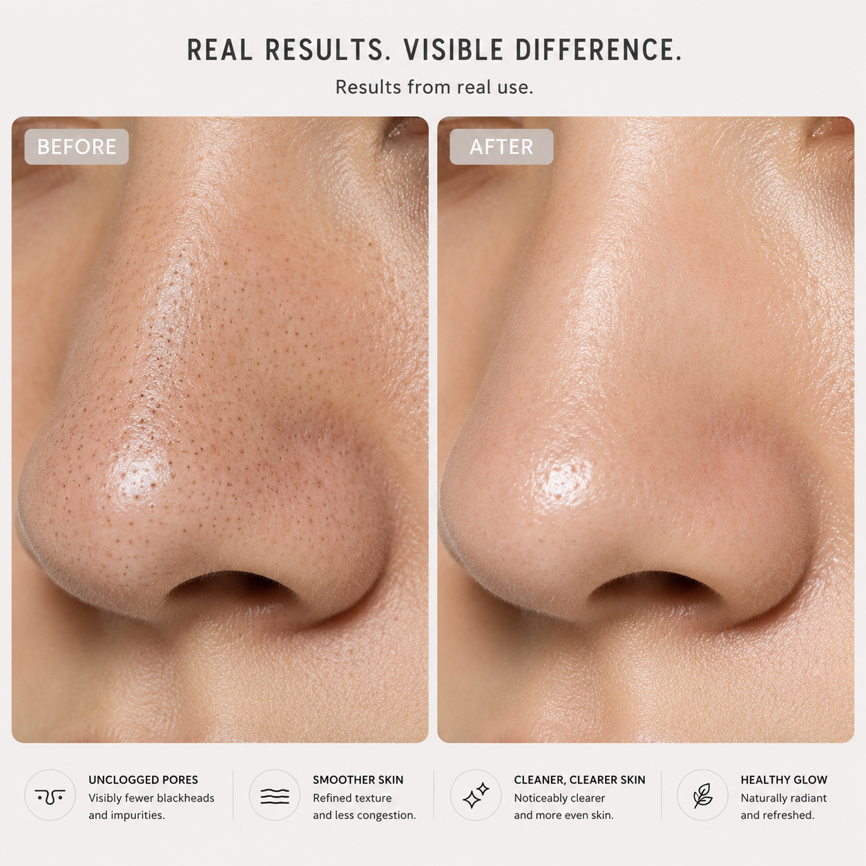 Before and after blackhead removal results using PoreSkn Pro+ pore vacuum device
