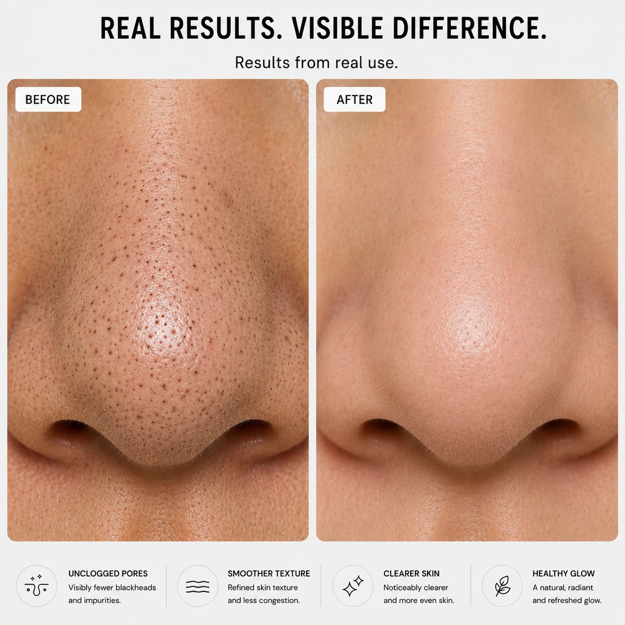 Before and after PoreSkn Pro+ pore extraction showing fewer visible blackheads and smoother-looking skin