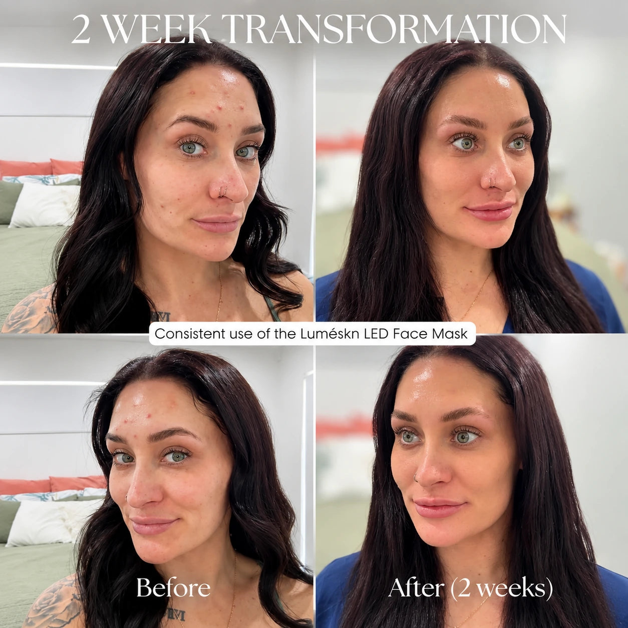 Luméskn LED Face Mask before and after results following two weeks of consistent use