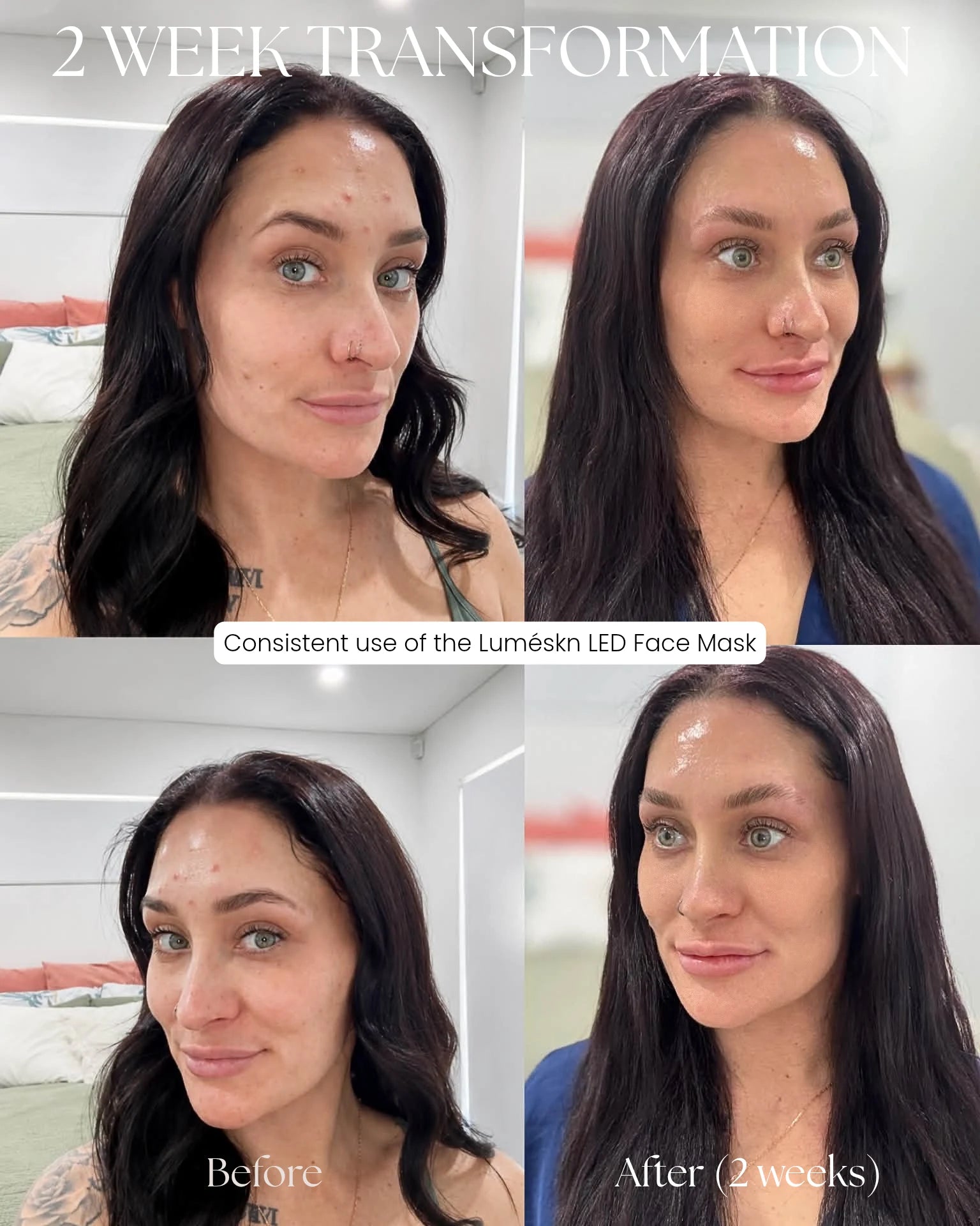Luméskn LED face mask before and after results following two weeks of consistent use